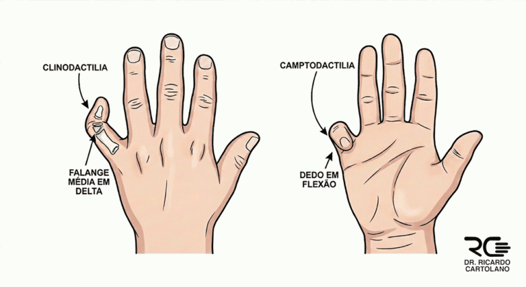 Ilustração médica comparativa das condições Clinodactilia e Camptodactilia no quinto dedo da mão.