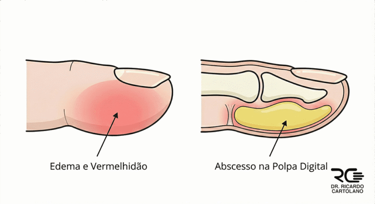 Ilustração médica de Felon, detalhando a infecção no dedo com abscesso na polpa digital e o edema externo.