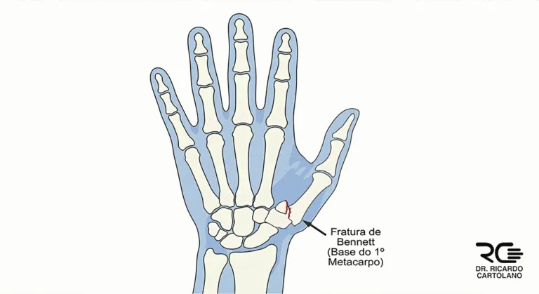 Ilustração médica detalhando a Fratura de Bennett na base do 1º metacarpo com desvio ósseo visível.