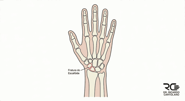 Ilustração médica esquemática de fratura do escafoide com desvio ósseo.