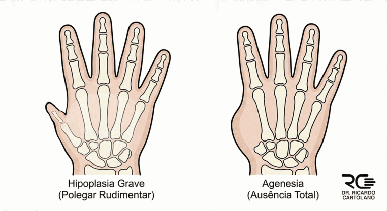 Ilustração comparativa de Hipoplasia (polegar rudimentar) e Agenesia do Polegar (ausência total) em mãos infantis.