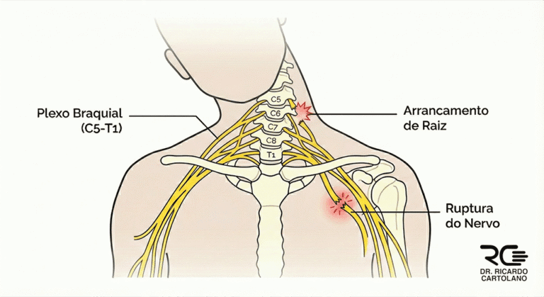 Ilustração médica da Lesão do Plexo Braquial, detalhando anatomia C5-T1, ruptura e arrancamento de raiz nervosa.