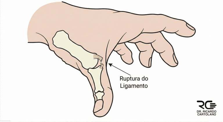 Ilustração da Lesão Ligamentar do Polegar (Polegar do Esquiador), detalhando a ruptura e Lesão de Stener.
