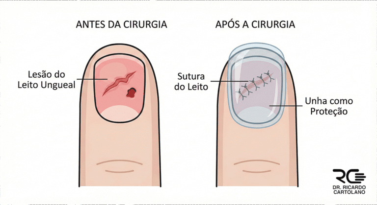 Lesões de Ponta de Dedo: reparo do leito ungueal com sutura e uso da unha como proteção.