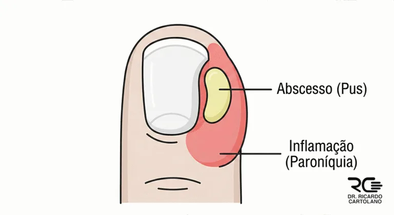 Ilustração médica explicativa da Paroníquia, mostrando a inflamação e o abscesso na lateral da unha.