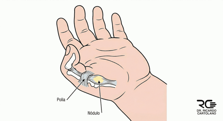 Ilustração médica do polegar em gatilho congênito infantil, detalhando o nódulo que trava o tendão flexor na polia A1.