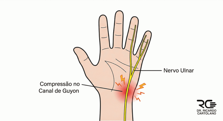 Ilustração da Síndrome do Canal de Guyon com compressão do nervo ulnar no punho.