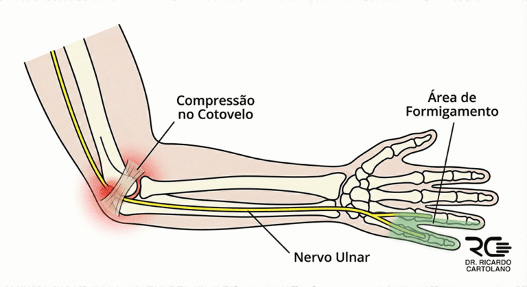 Ilustração da Síndrome do Túnel Cubital: compressão do nervo ulnar no cotovelo e formigamento nos dedos mínimo e anelar.
