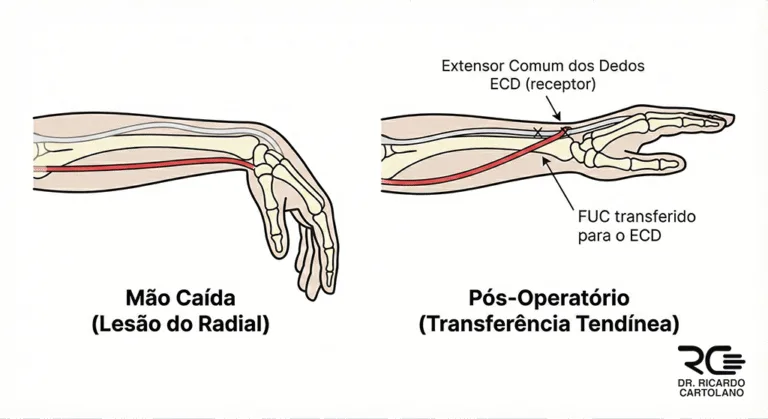 Ilustração de antes e depois de Transferências Tendíneas para correção de mão caída (lesão do nervo radial).
