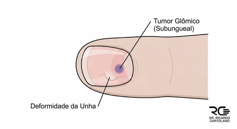 Ilustração médica de um Tumor Glômico subungueal, visível através da unha com leve deformidade.