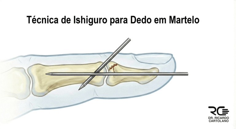 Fixação com fios de Kirschner (Ishiguro) para Dedo em Martelo.