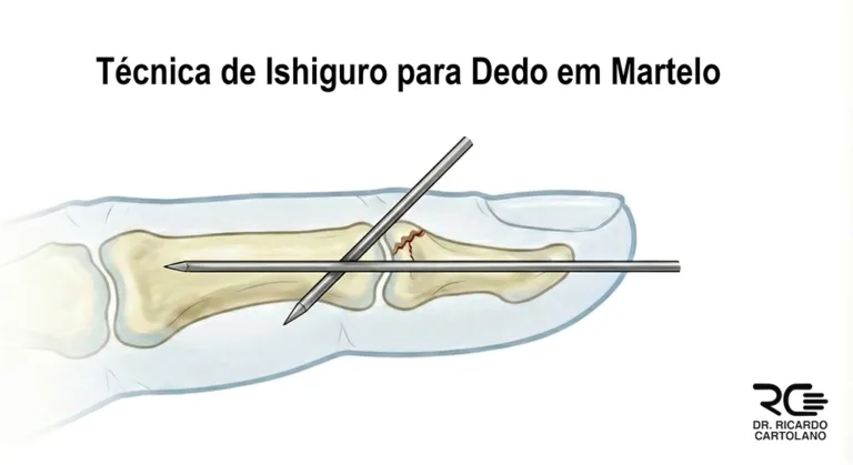 Fixação com fios de Kirschner (Ishiguro) para Dedo em Martelo.