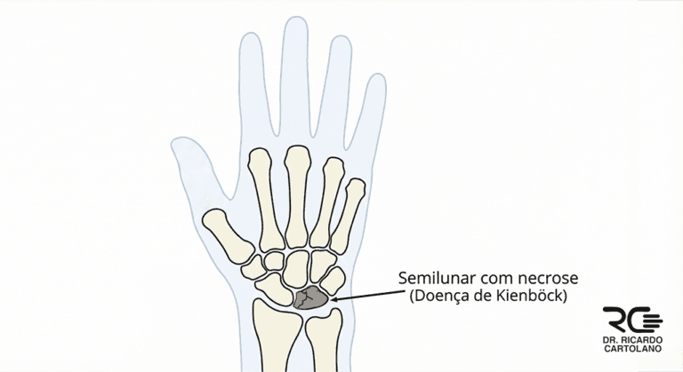 Ilustração médica vetorial do punho afetado pela Doença de Kienböck, destacando a necrose avascular no osso semilunar.