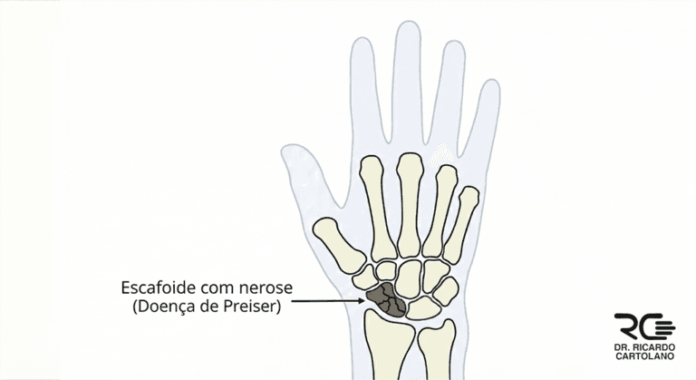 Ilustração médica vetorial do punho afetado pela Doença de Preiser, destacando a necrose avascular no osso escafoide.