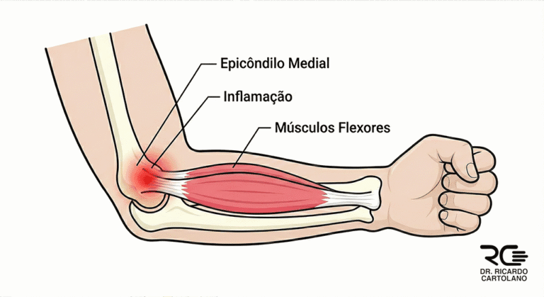 Ilustração médica da Epicondilite Medial (cotovelo de golfista) mostrando a inflamação.