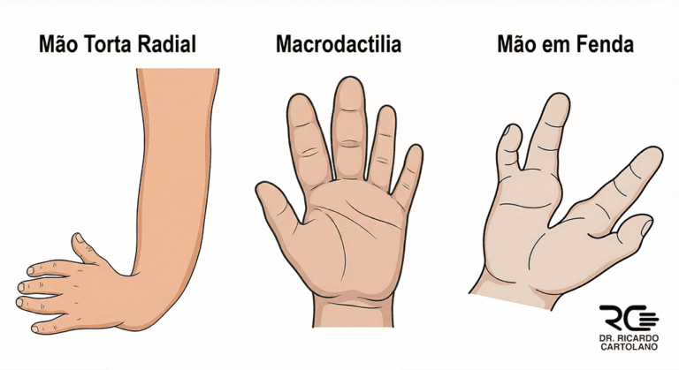 Esquema visual de malformações congênitas da mão: Mão em Fenda, Macrodactilia e Mão Torta Radial.