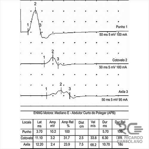 Teste elétrico dos nervos (Eletroneuromiografia) sendo realizado para avaliar a velocidade do impulso nervoso e diferenciar compressões na mão de lesões na coluna.