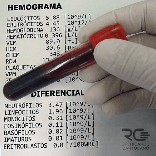 Foto de um tubo de ensaio com sangue posicionado em cima de um laudo laboratorial impresso, destacando os valores da série vermelha e branca do hemograma.