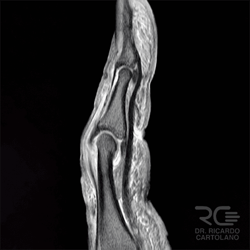 Ressonância Magnética do dedo em corte sagital: imagem de alta definição das falanges e partes moles. Padrão-ouro para diagnóstico de lesões ligamentares, tumores e necrose óssea.