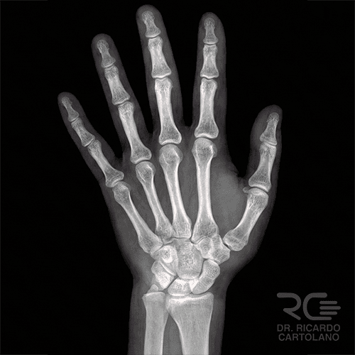 Radiografia do punho em incidência AP (Anteroposterior). Exame real exibindo a estrutura óssea do rádio, ulna e carpo para diagnóstico de fraturas e artrose.