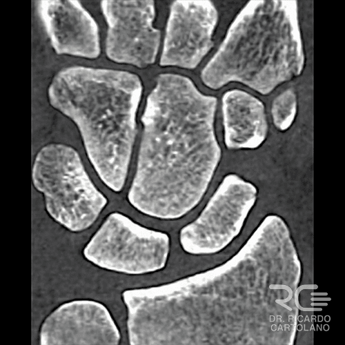 Imagem de corte coronal de Tomografia do punho, exibindo a anatomia interna dos ossos e a congruência articular com alta definição, superior ao Raio-X convencional.