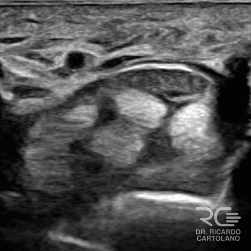 Ultrassonografia do túnel do carpo: imagem real destacando o nervo mediano e os tendões flexores. Exame dinâmico essencial para diagnosticar compressão nervosa e guiar infiltrações.