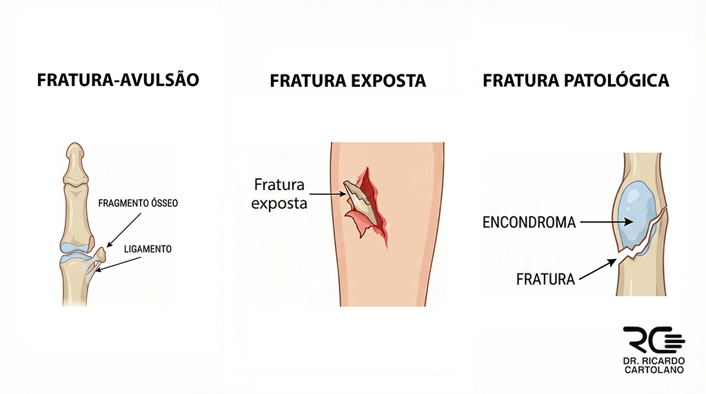 Ilustração médica comparativa de três tipos de fraturas: Fratura-Avulsão (arrancamento ósseo por ligamento ou tendão), Fratura Exposta (osso perfurando a pele com risco de infecção) e Fratura Patológica (quebra em osso fragilizado por cisto ou tumor).